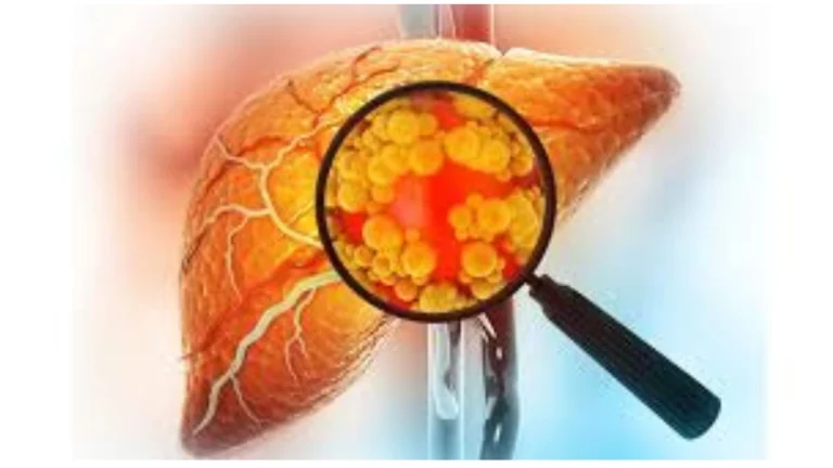 Fatty Liver Disease